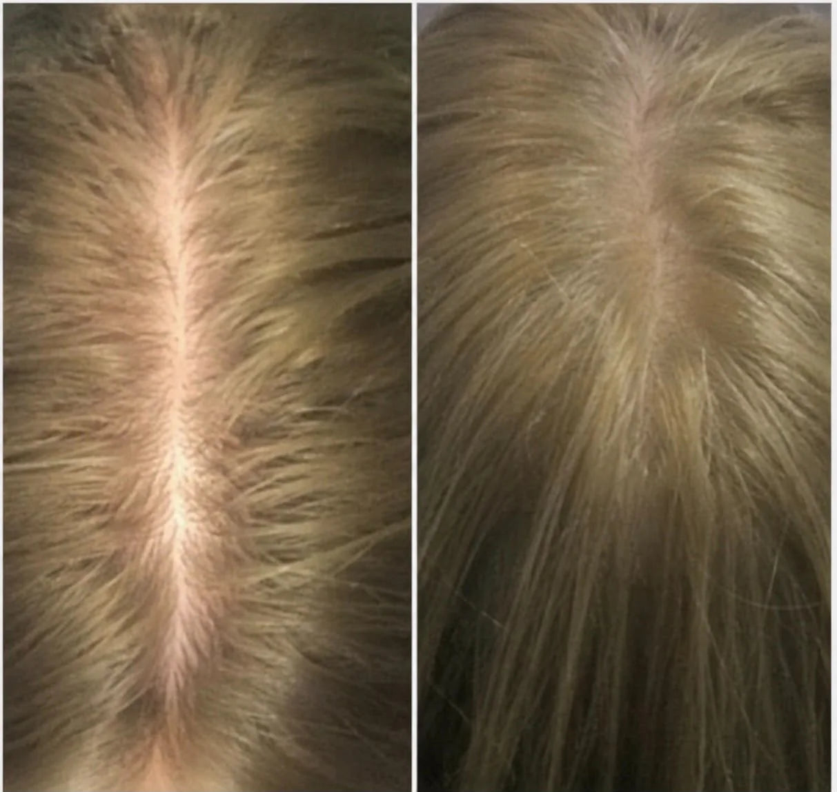 A customer photographed before and after taking PWRRR Beauty Collagen daily. A noticeably narrower parting and fuller hair along the crown in the second photograph.